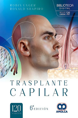 Trasplante Capilar