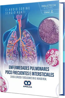 Enfermedades Pulmonares poco Frecuentes e Intersticiales